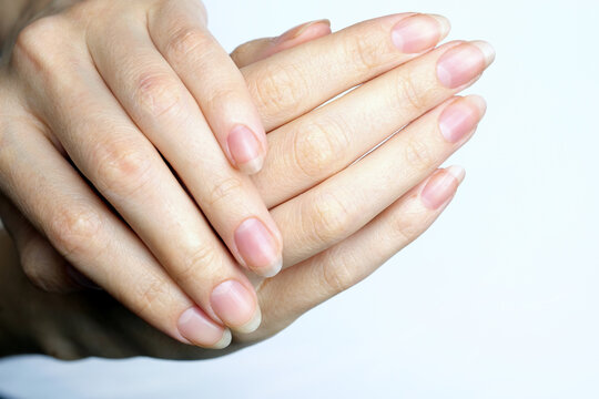 Green Nails: Understanding and Treating This Condition